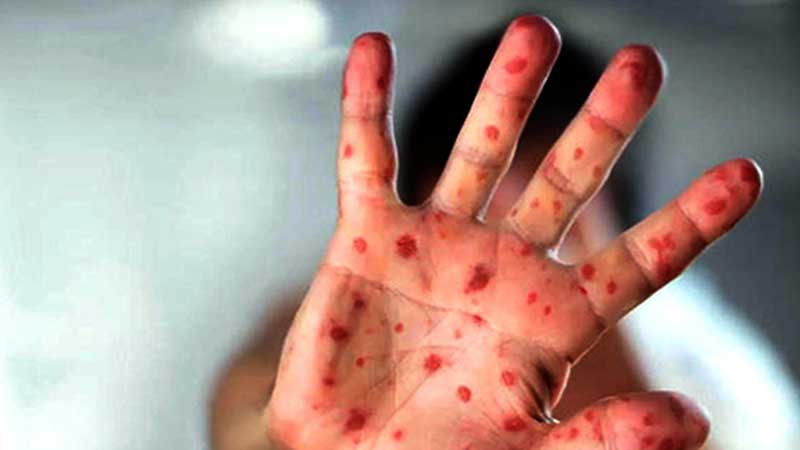 Health Ministry records no new measles cases since last month