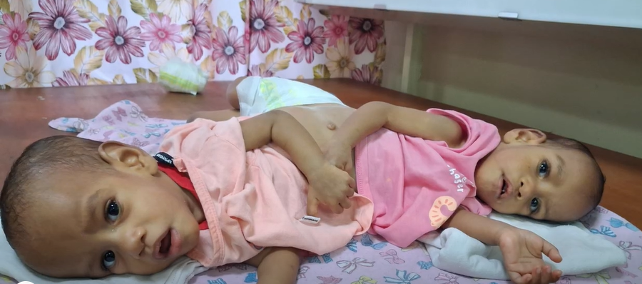 Conjoined twins mother hopeful her babies will live a normal life after surgery
