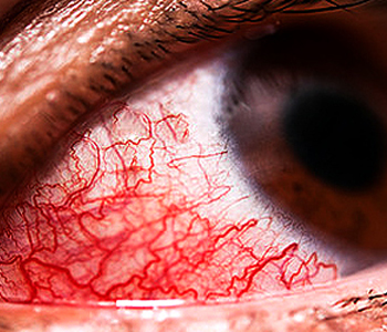 Students with conjunctivitis told to stay home