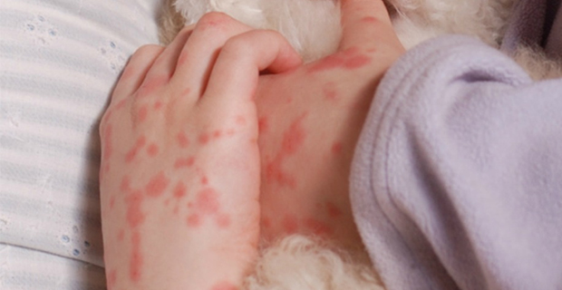 Serious concerns raised regarding pharmacies raising the price for meningococcal vaccine