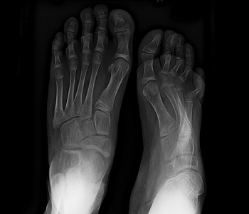  Amputation rate in Fiji increases 