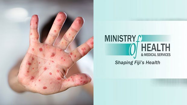 Health Ministry alerting public on a single travel-related case of measles from the Philippines