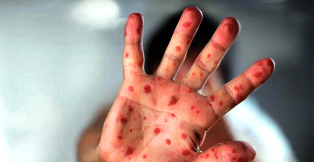 Health Ministry believes measles came into Fiji through a relative of someone in Wailali Settlement 