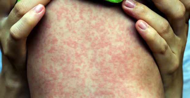 3 more measles cases have been confirmed from the Serua/Namosi subdivision