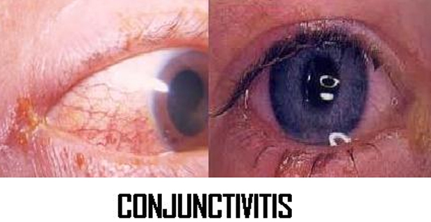 Increase in number of conjunctivitis cases or 'cika' recorded in different parts of Fiji